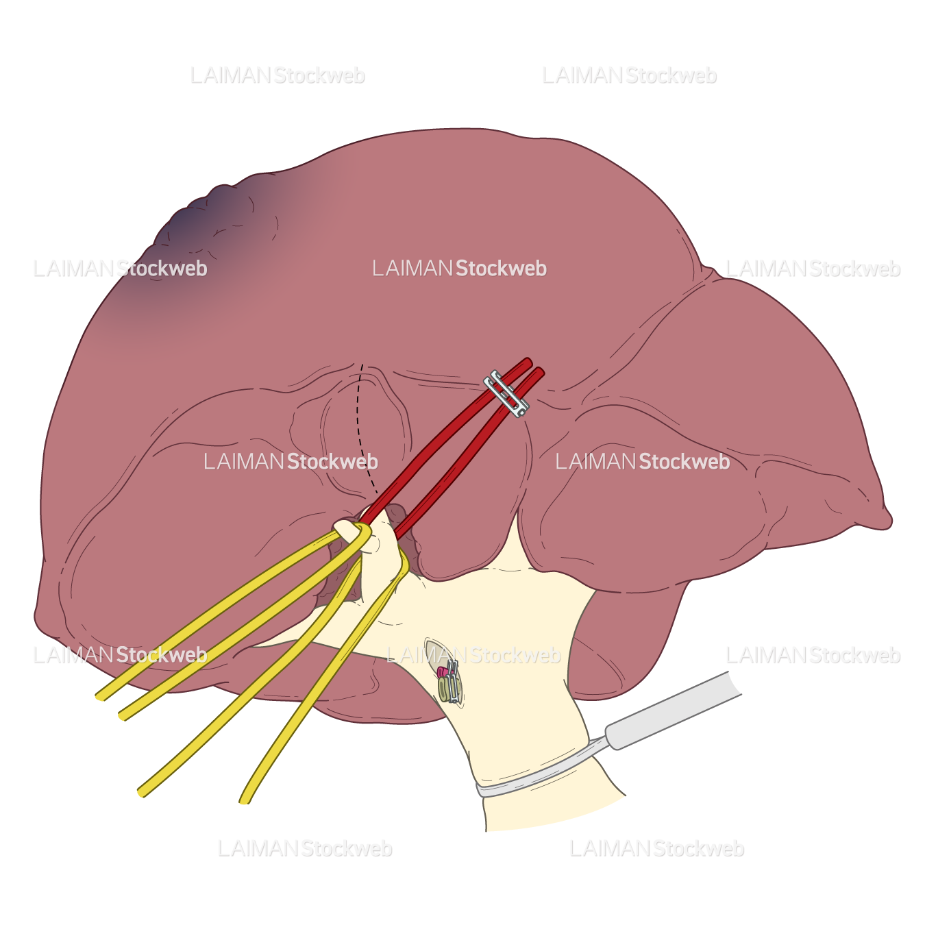 S8切除 (肝門部からG8を掘って同定しテーピング)