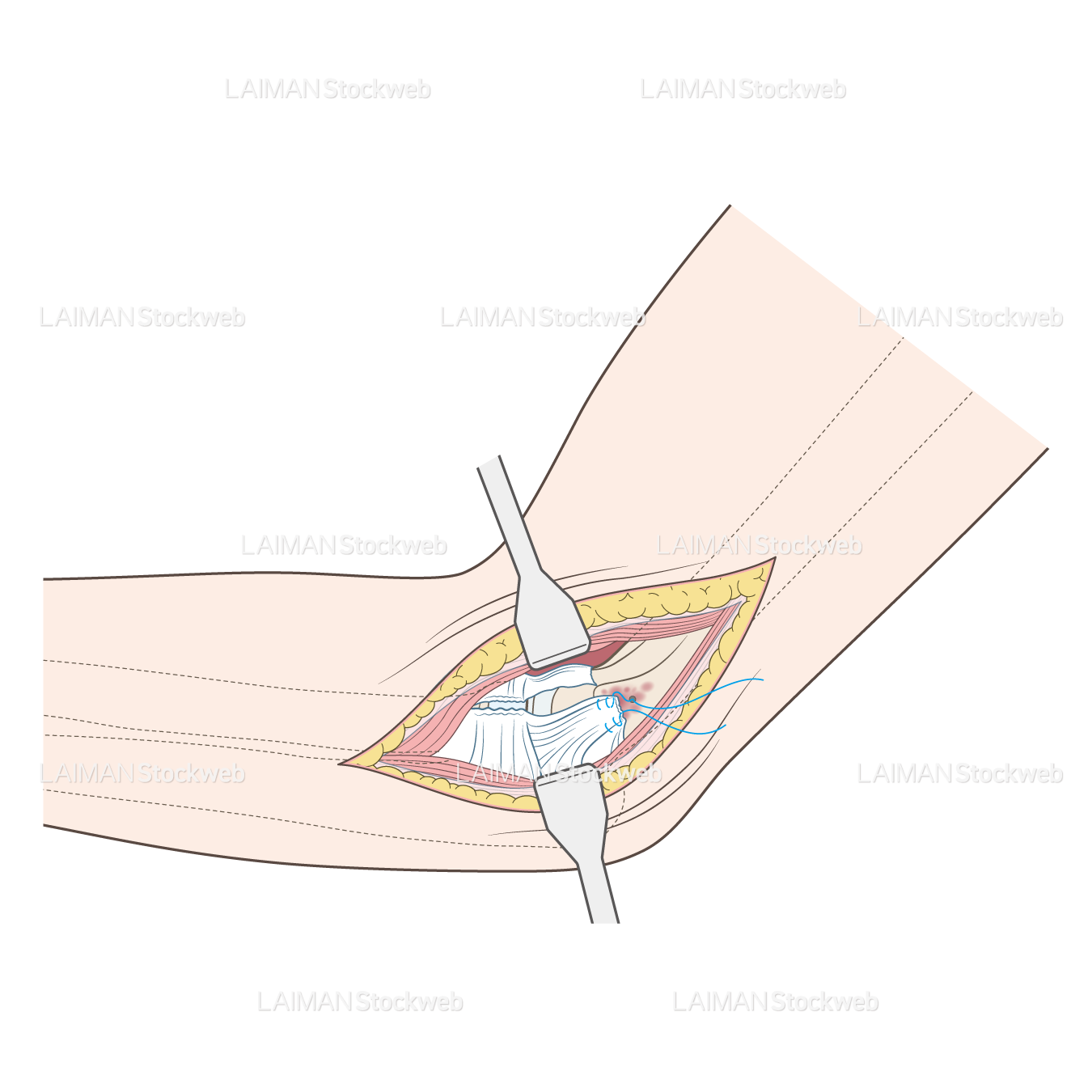 橈骨頭骨折と外側側副靱帯の修復 :LCLの同定
