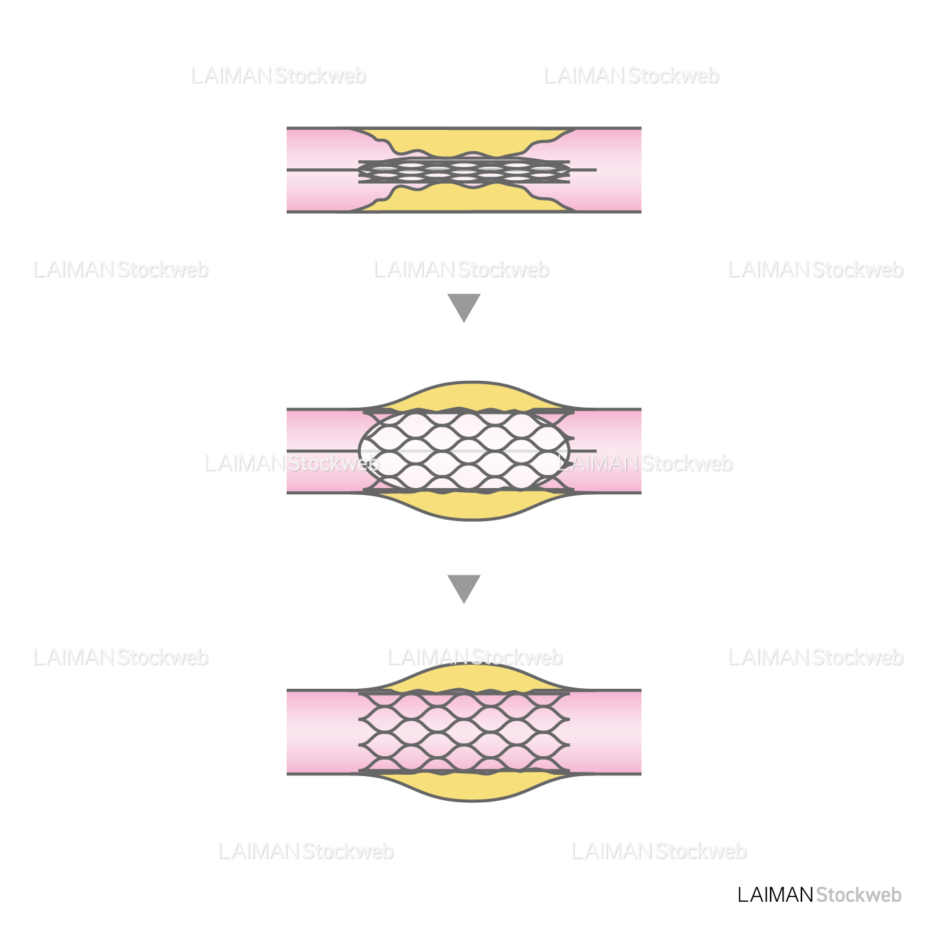 経皮的冠動脈形成術(ステント治療)