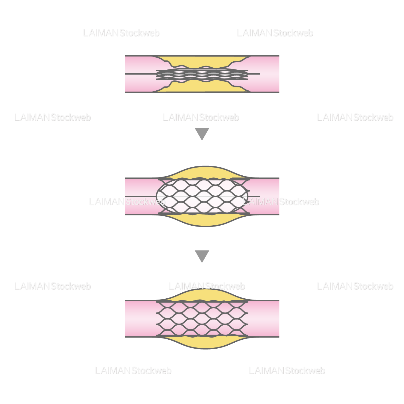 経皮的冠動脈形成術(ステント治療)