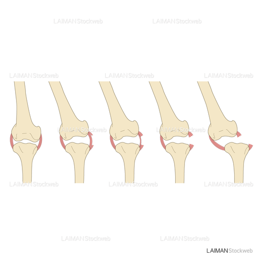 捻挫(靭帯損傷とその程度)