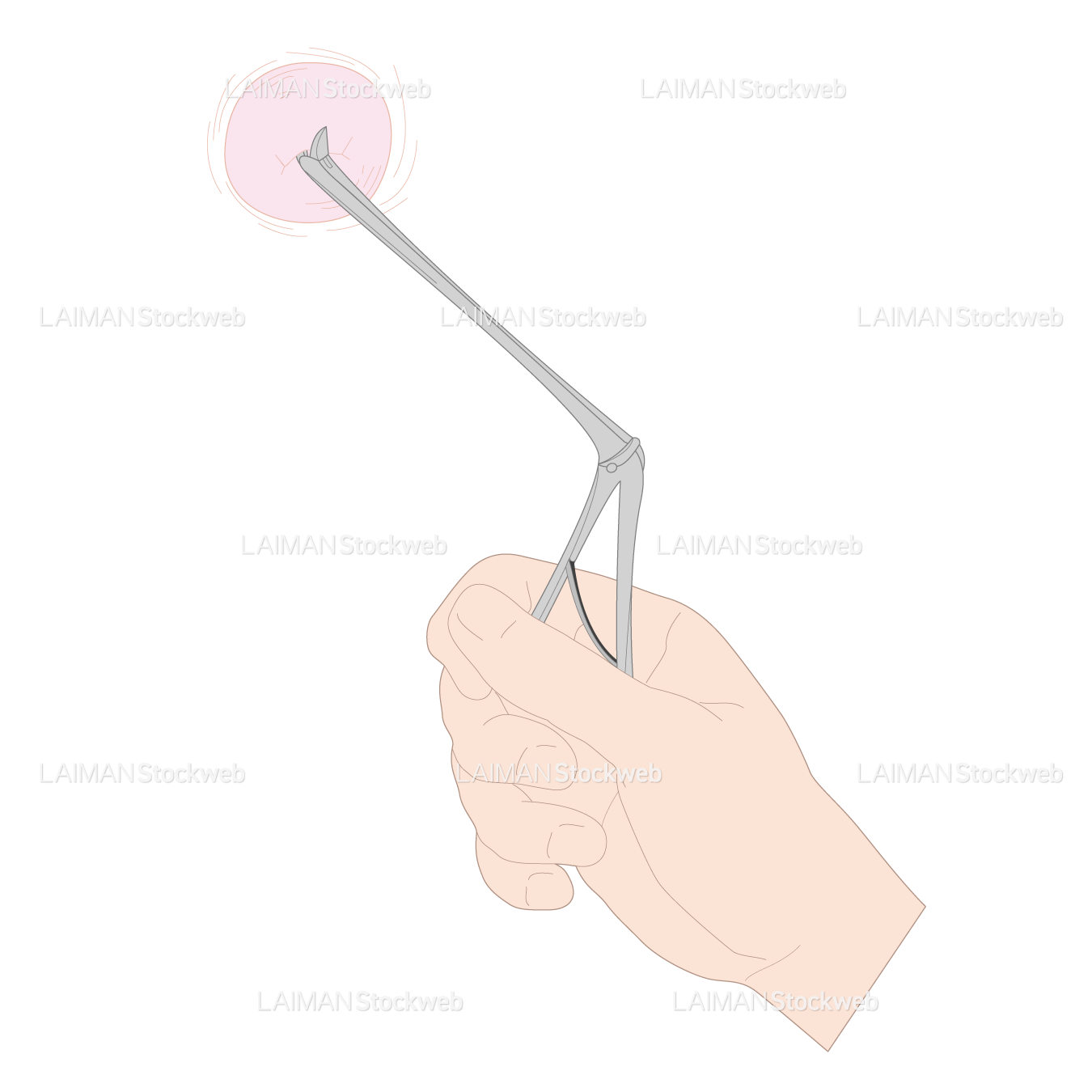 婦人科/組織学的検査/試験切除器