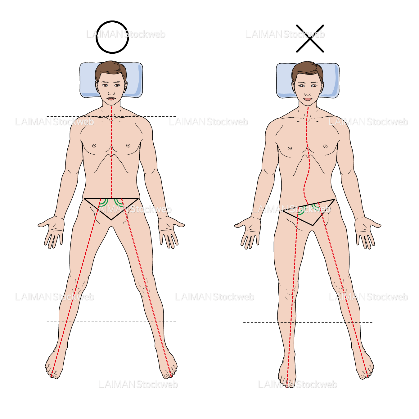 大腿骨頚部骨折患者の良肢保持/外転位