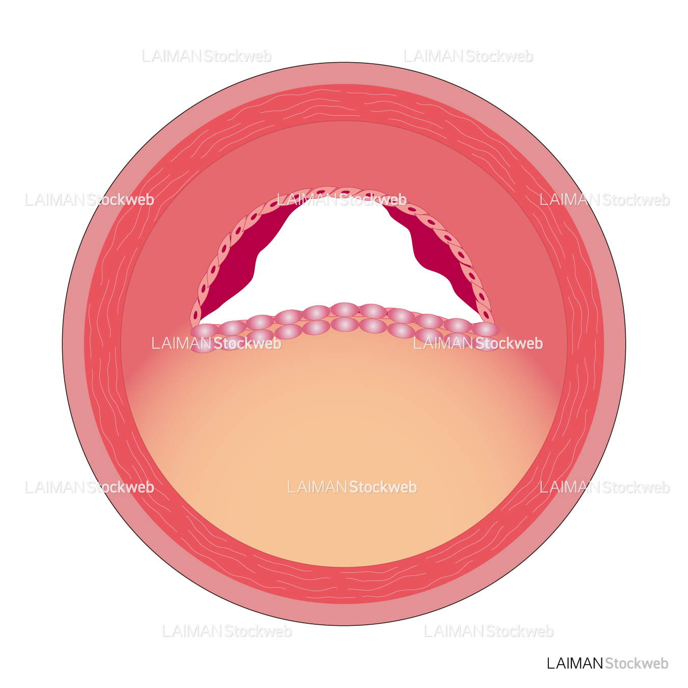 冠動脈のアテローム硬化