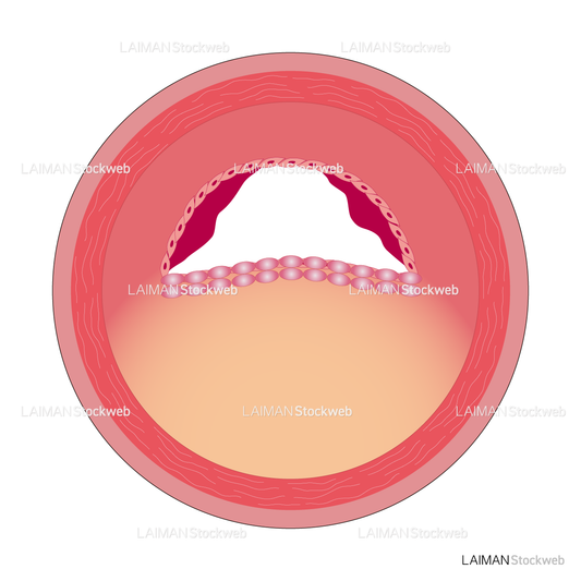 冠動脈のアテローム硬化
