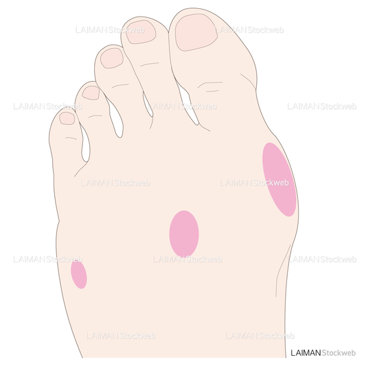 主な痛みの発現部位と原因疾患(疲労骨折・外反母趾)