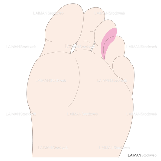 主な痛みの発現部位と原因疾患(種子骨障害・モートン神経腫)