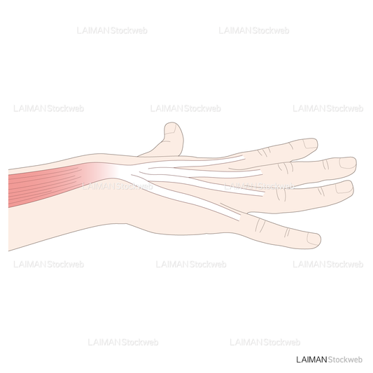 神経根障害高位診断(指伸筋)