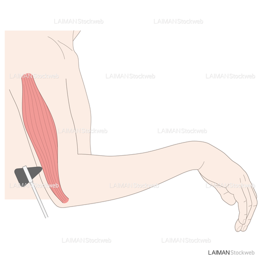 神経根障害高位診断(上腕三頭筋)