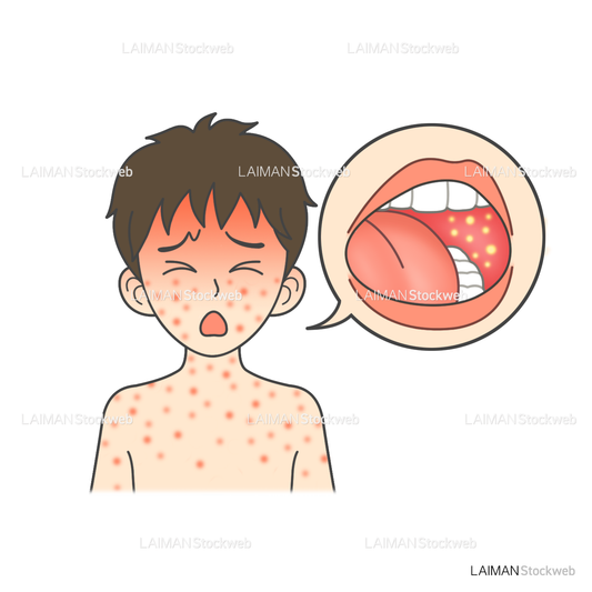 患者イラスト 麻疹(はしか)
