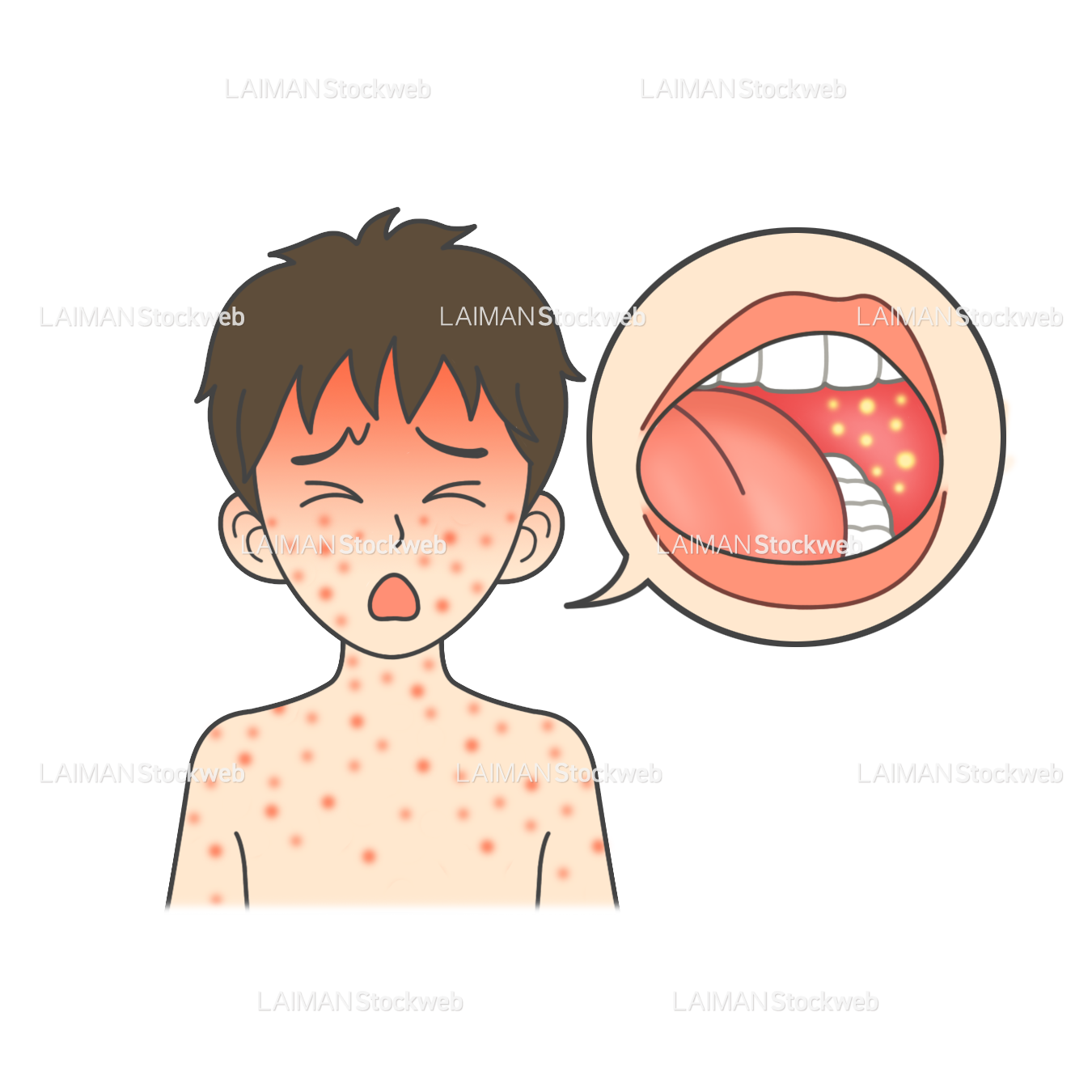 患者イラスト 麻疹(はしか)