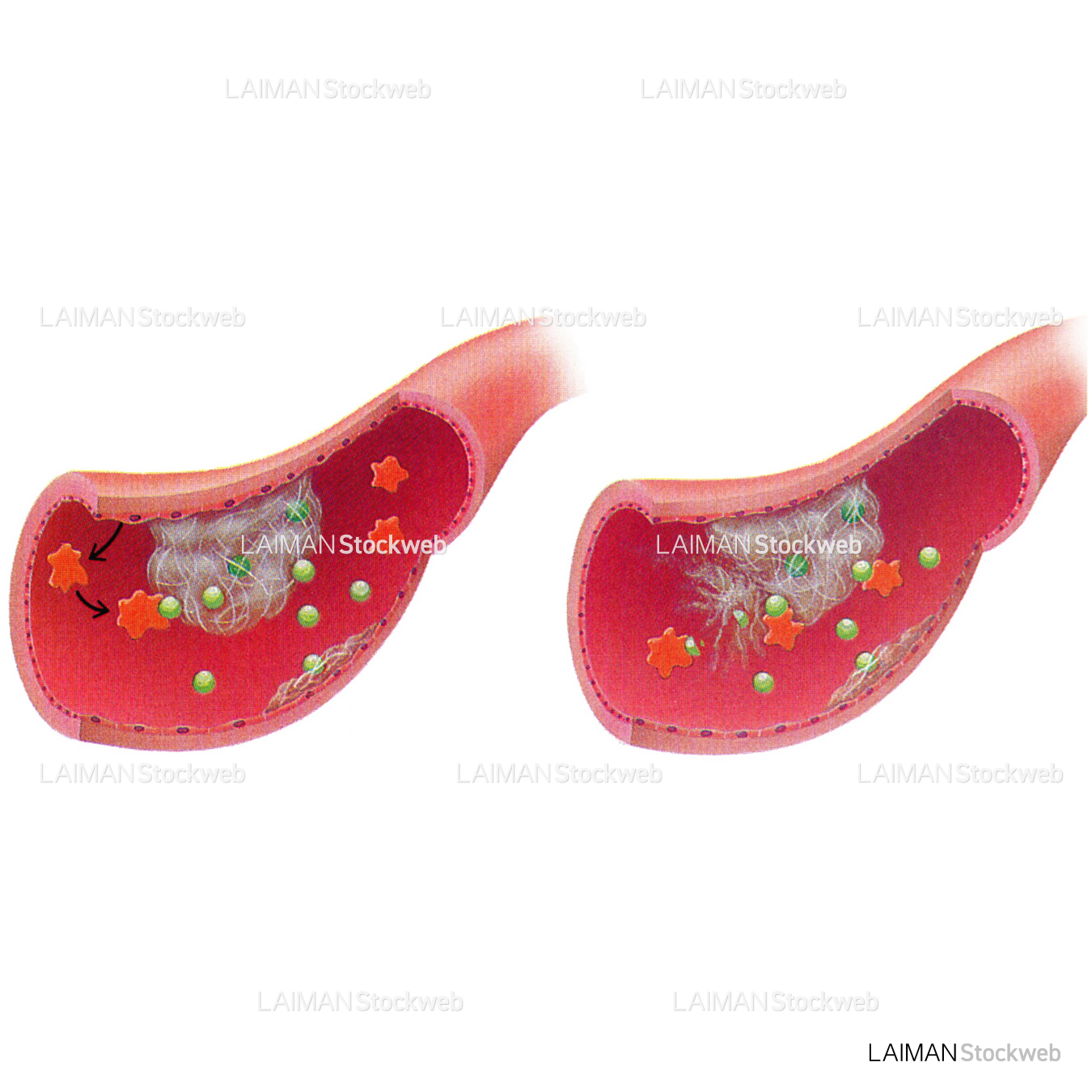 tPAによる血栓溶解(脳卒中治療)