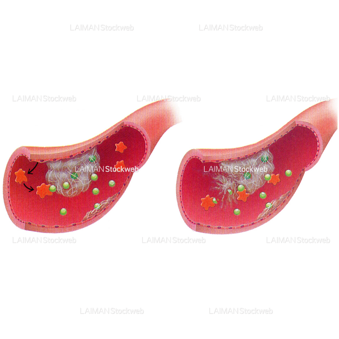tPAによる血栓溶解(脳卒中治療)