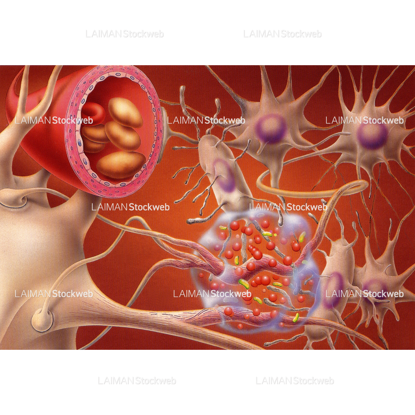 アミロイドβタンパク質(変形した軸索)