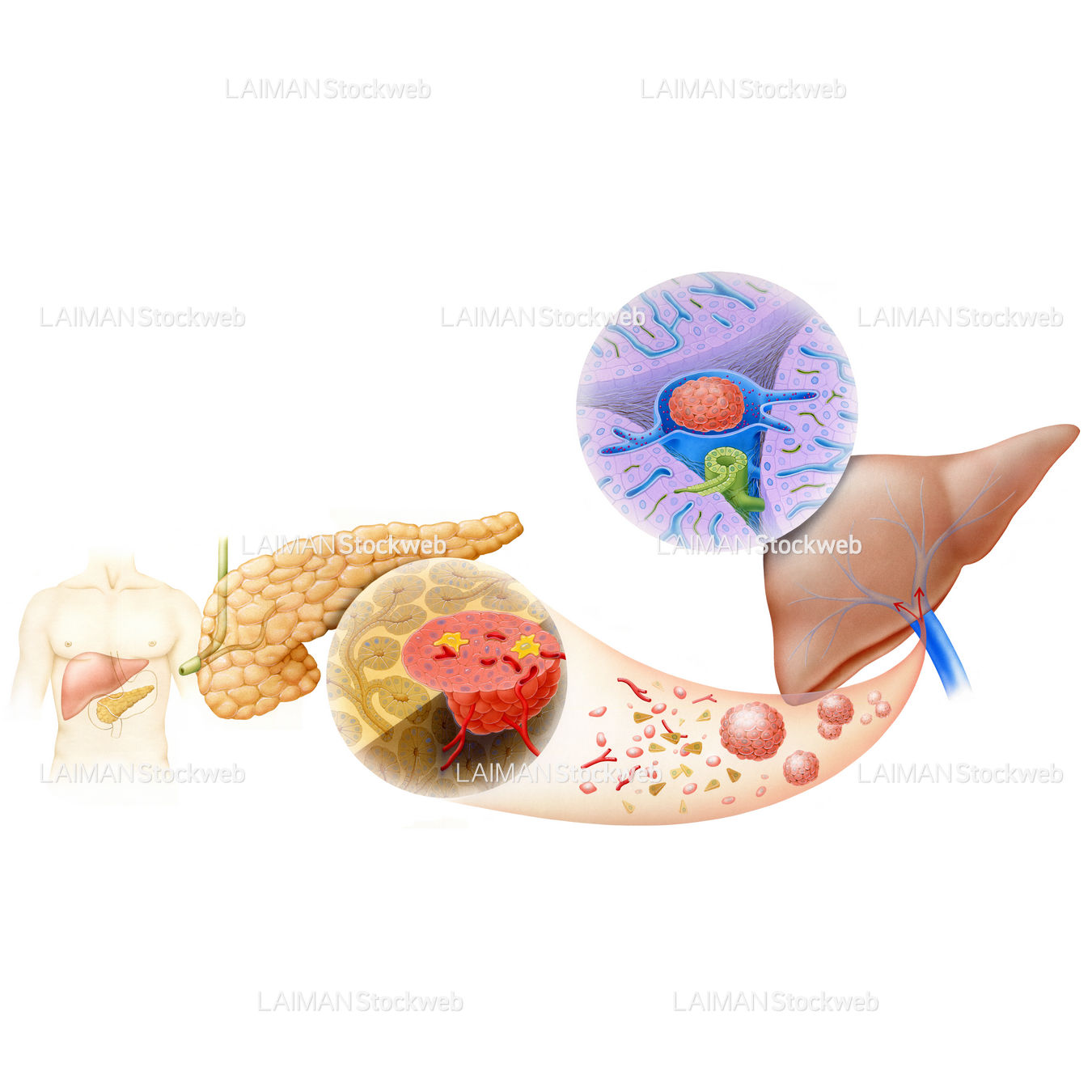 膵島移植(糖尿病)