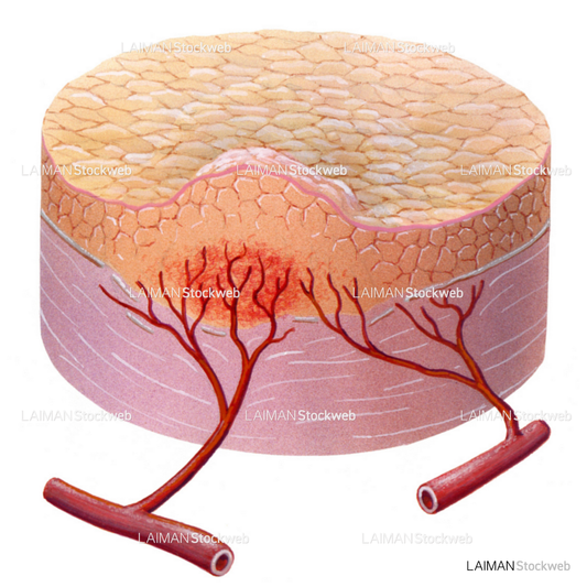血管形成2(/5)(がんと血液供給)