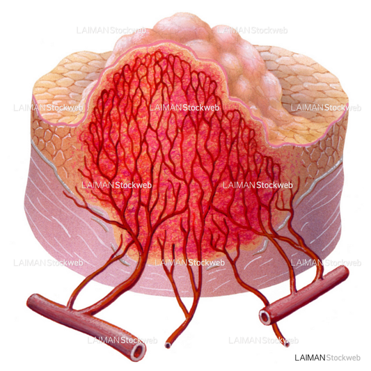 血管形成5(/5)(がんと血液供給)