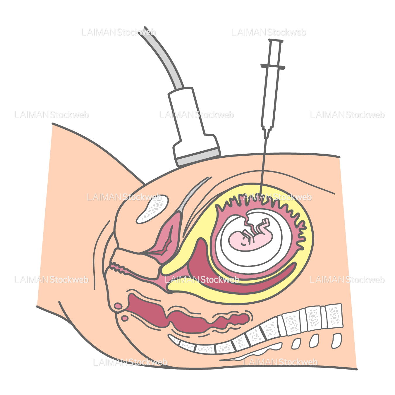 遺伝学的検査:絨毛検査