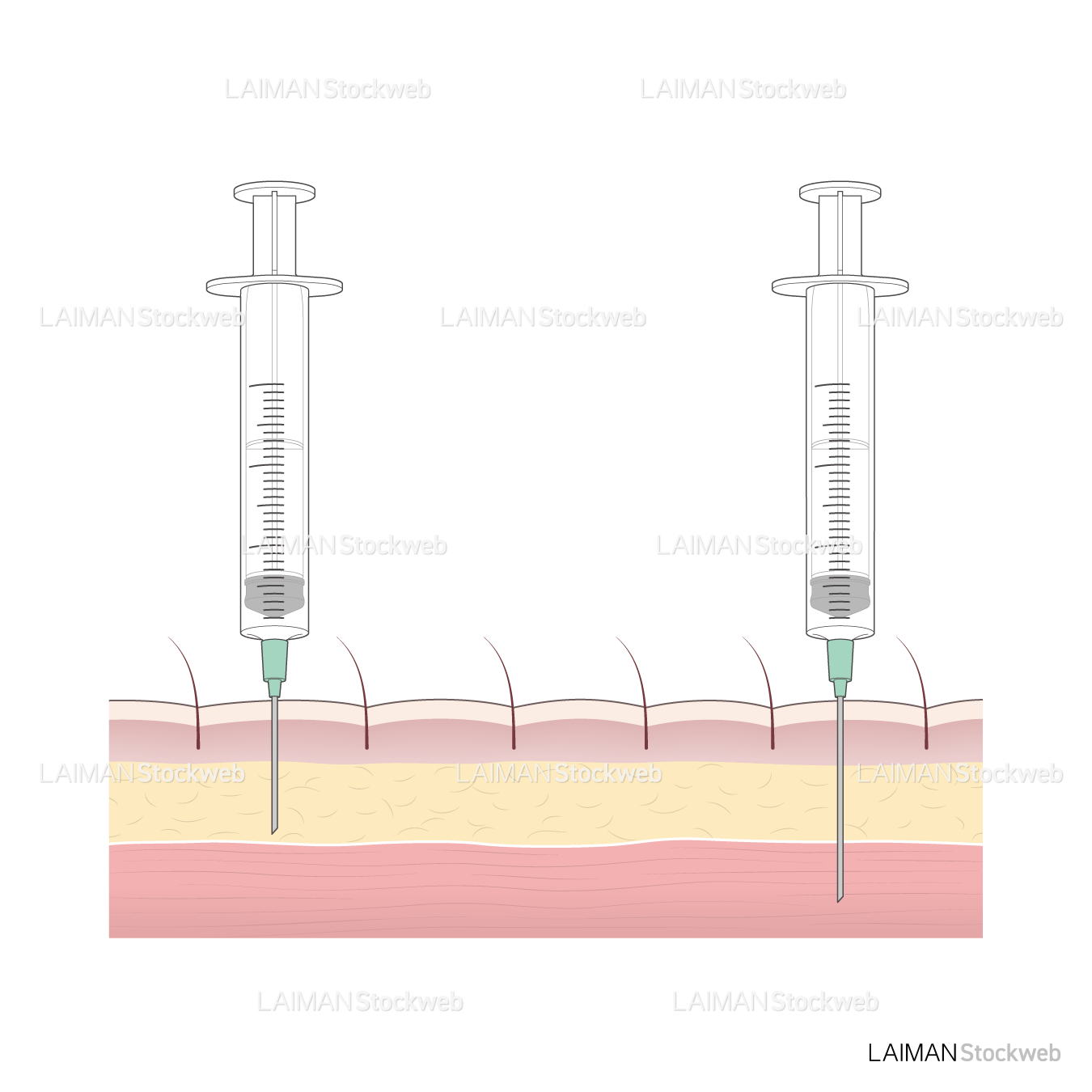 皮下注射・筋肉注射