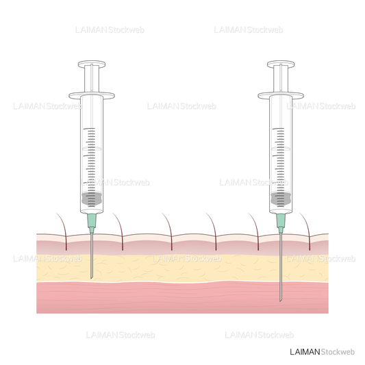 皮下注射・筋肉注射