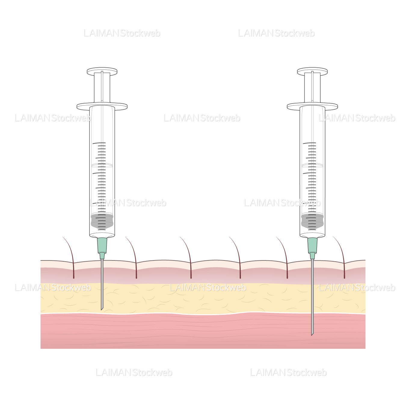 皮下注射・筋肉注射