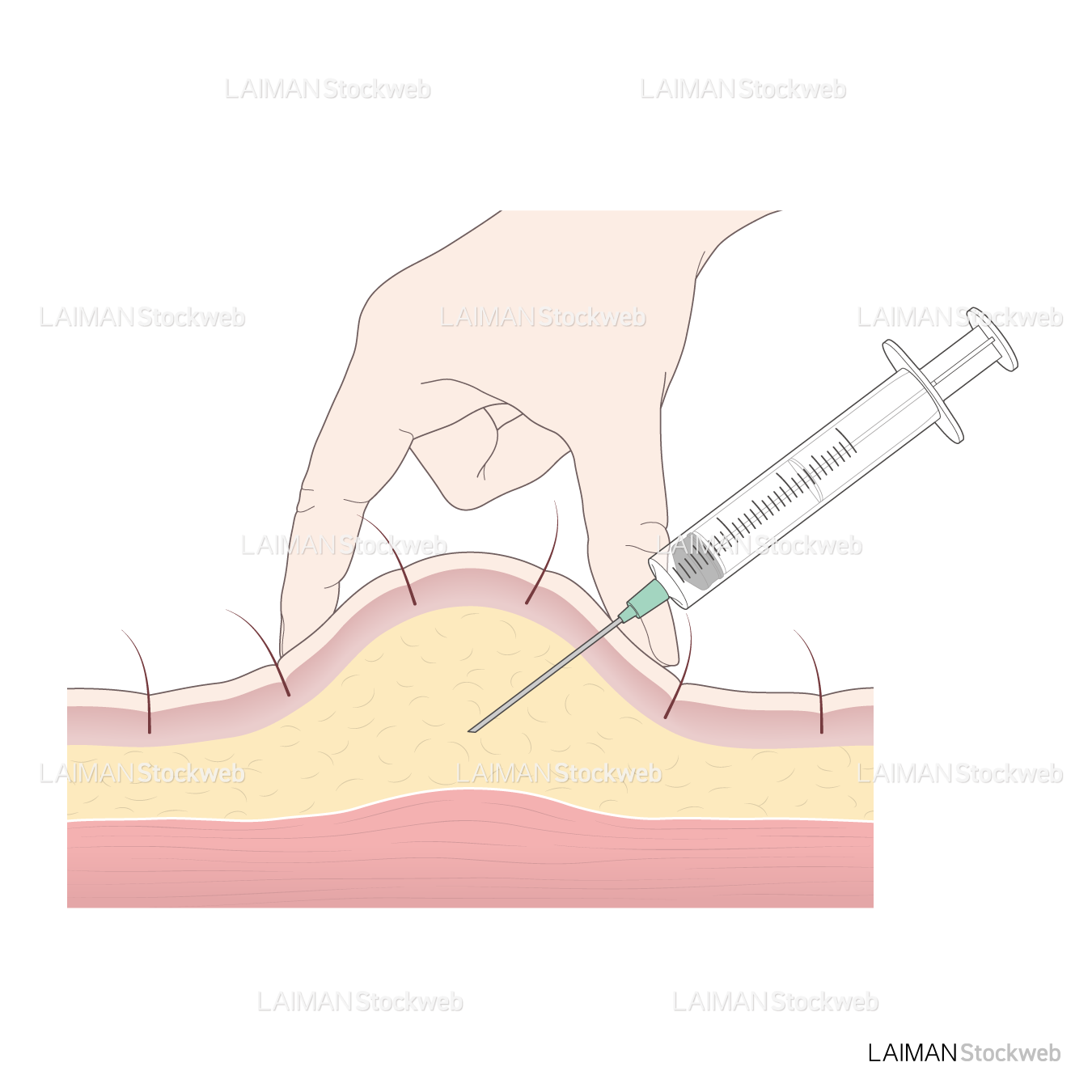 皮下注射（皮膚の厚いところ）