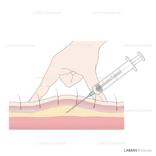 皮下注射（皮膚の薄いところ）