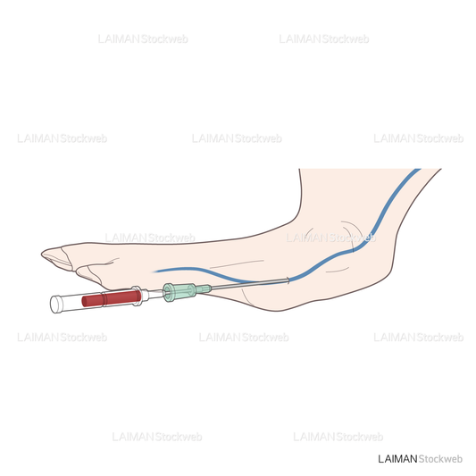 留置針を用いた採血
