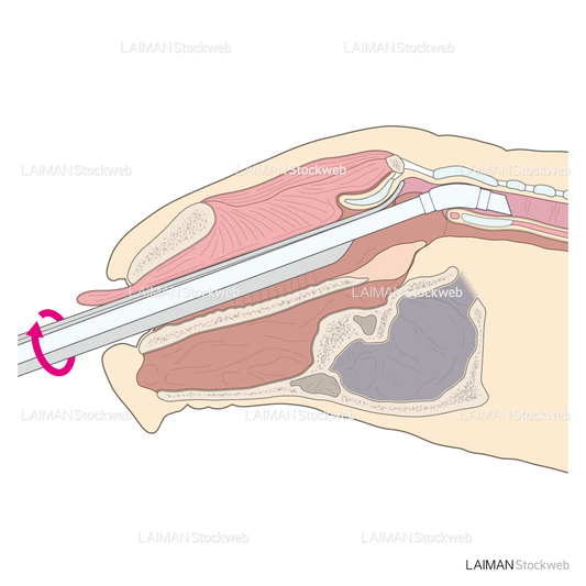 気管挿管/気管チューブを回す