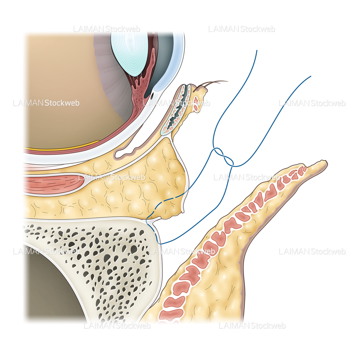 骨膜との縫合図