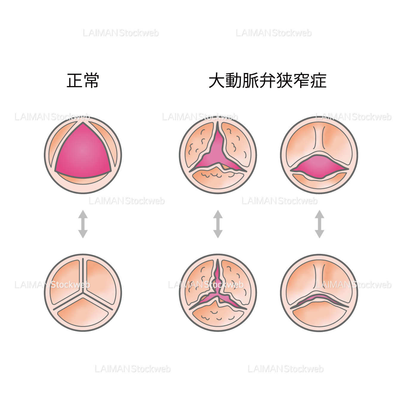 大動脈弁の状態の比較