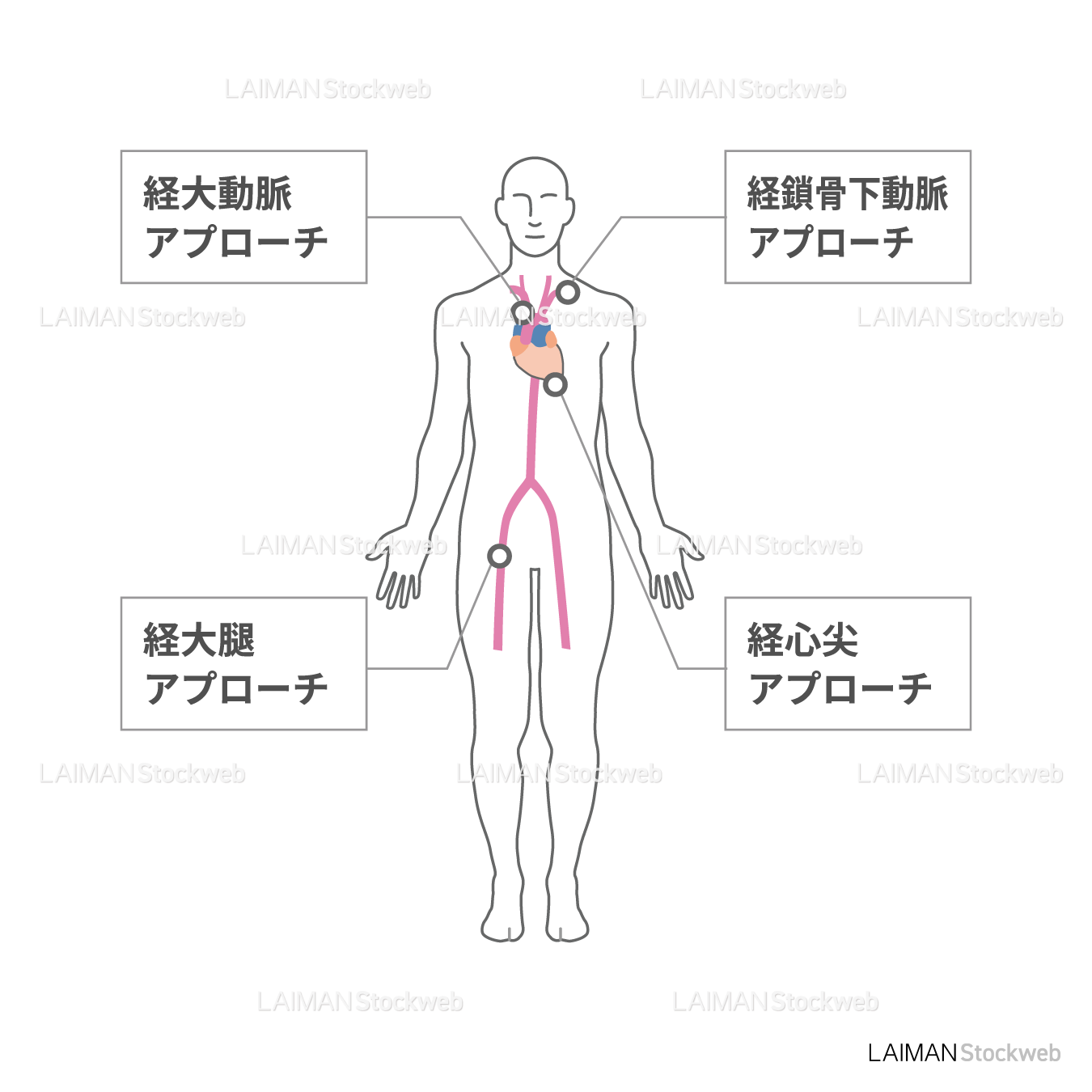 TAVIにおけるカテーテル挿入経路