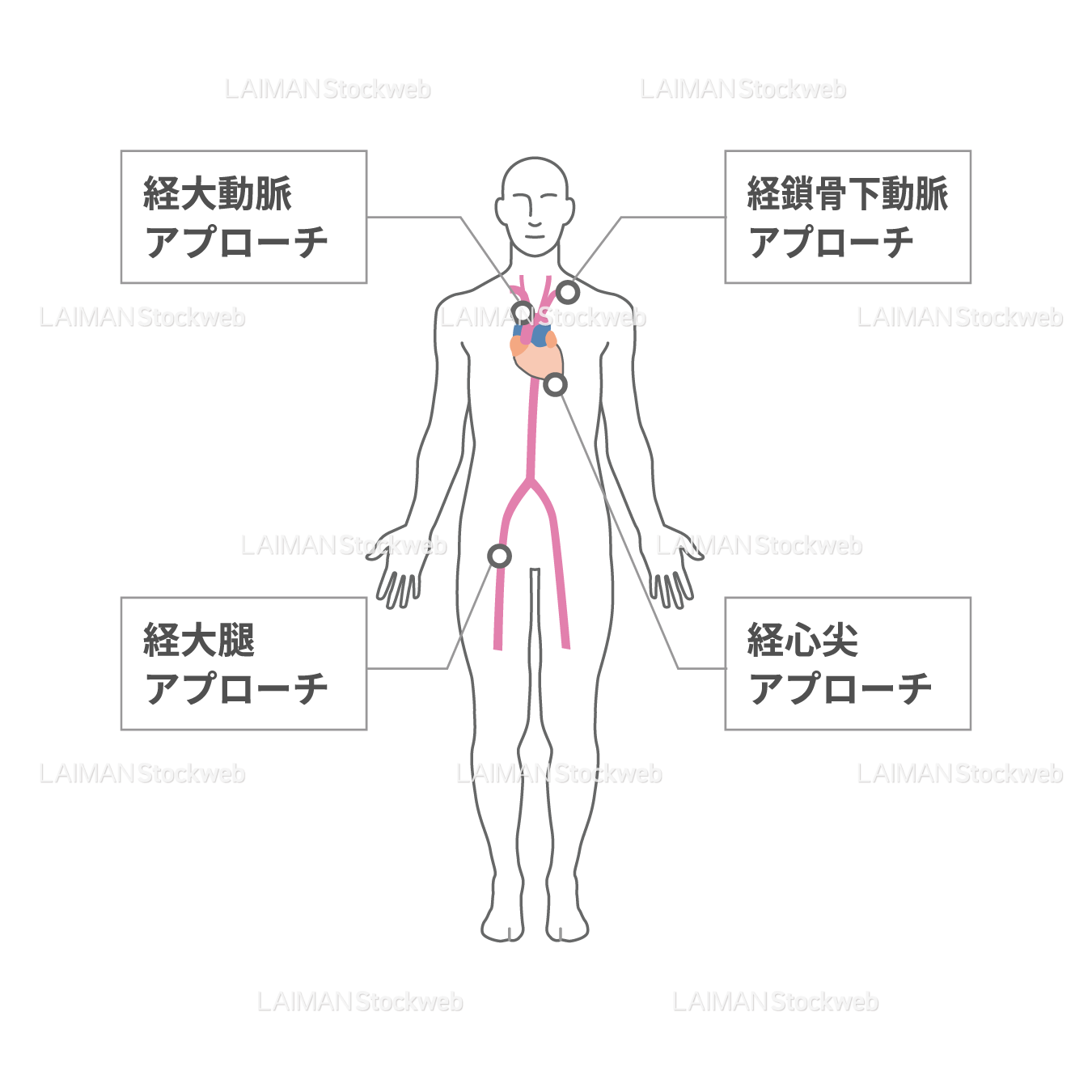 TAVIにおけるカテーテル挿入経路