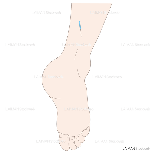 下腿背側への鍼通電