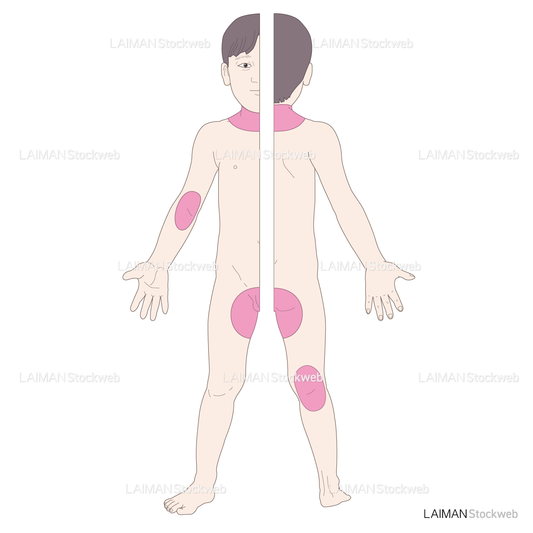 小児の汗疹好発部位