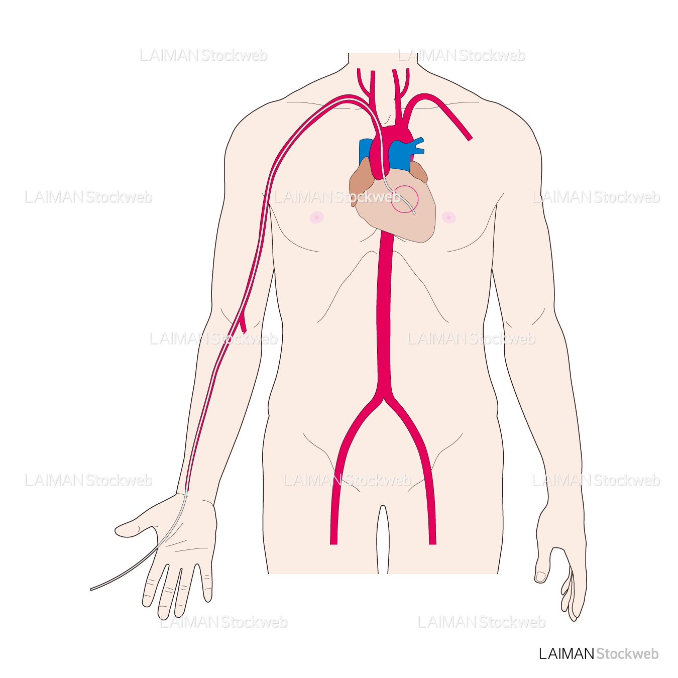 カテーテルの挿入部位