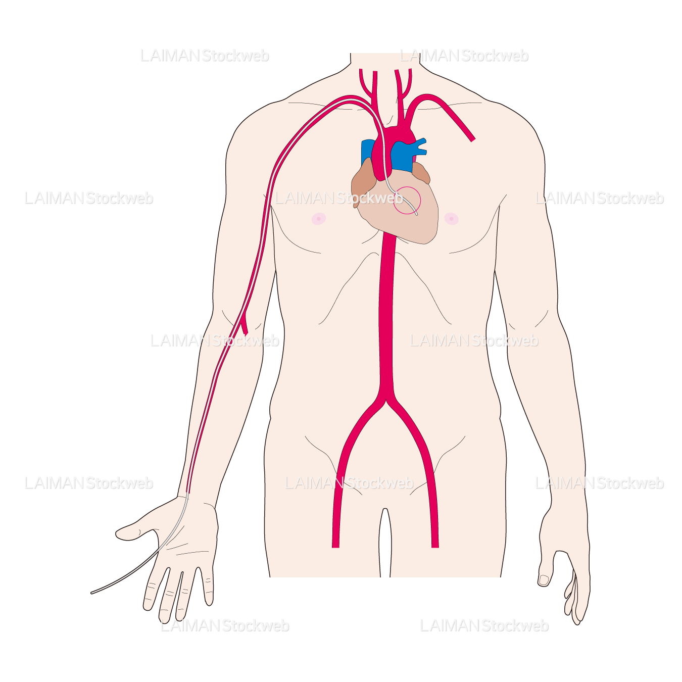 カテーテルの挿入部位