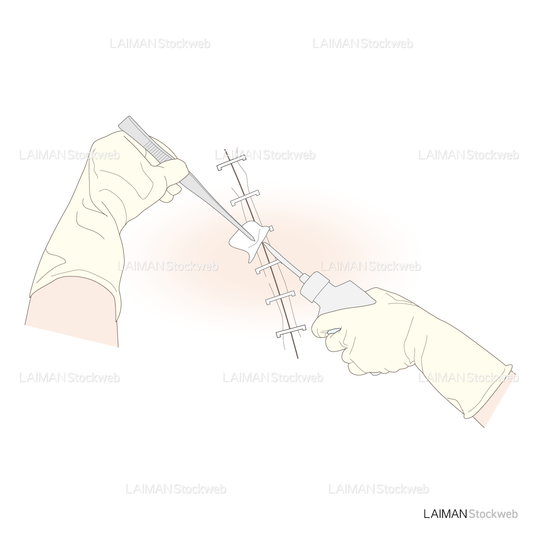 ドレッシングの方法／手術創を線上する