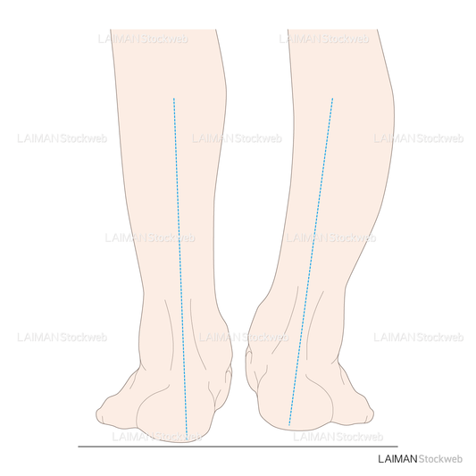 下腿のアライメント 踵部内反