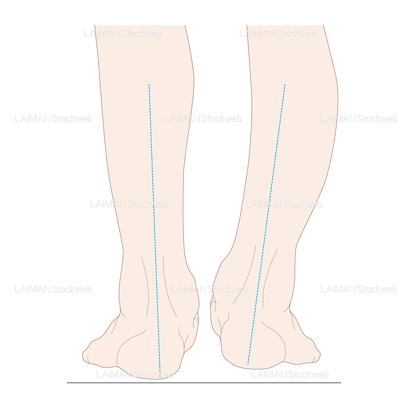 下腿のアライメント 踵部内反