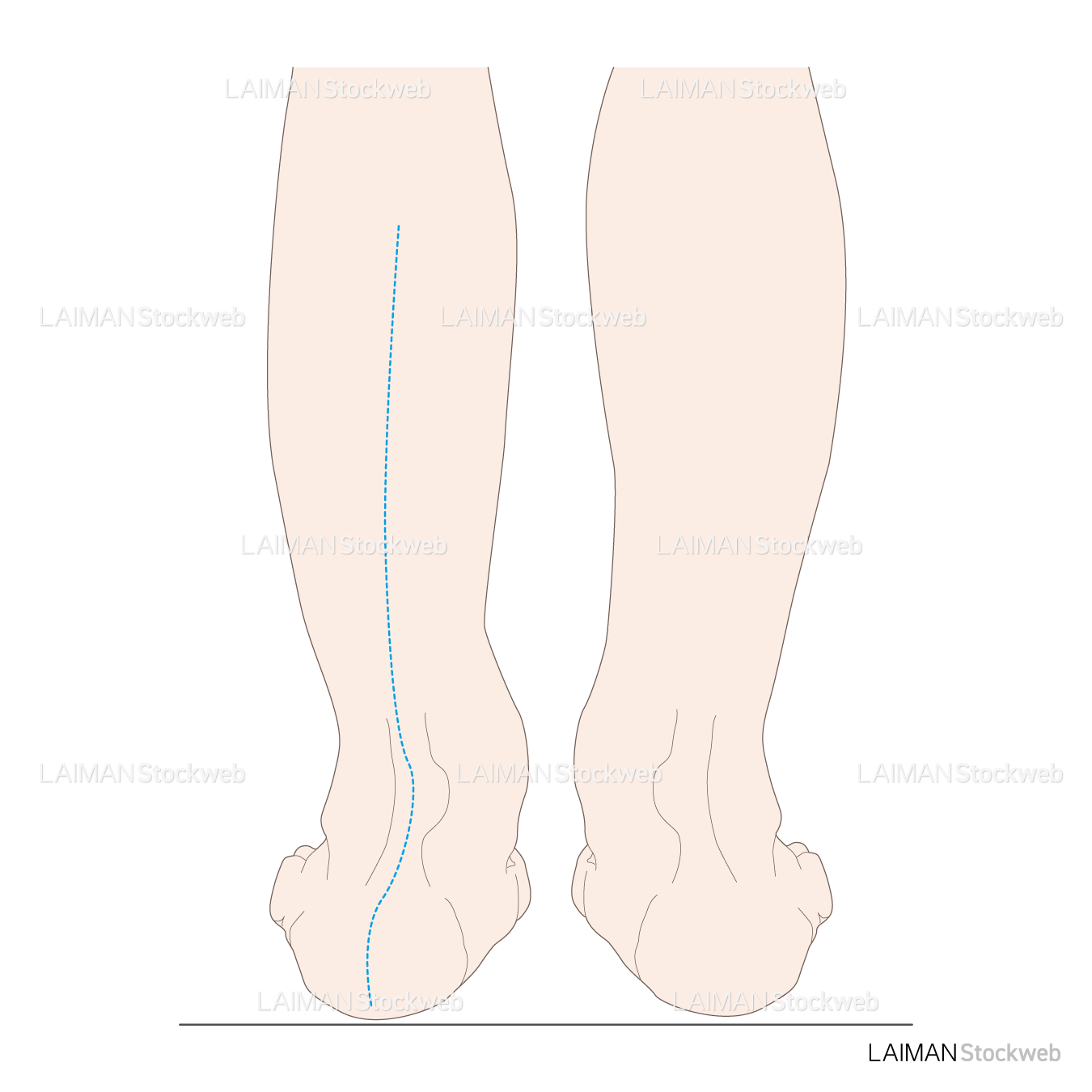 下腿のアライメント 踵部外反