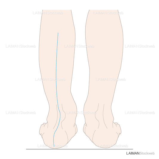 下腿のアライメント 踵部外反