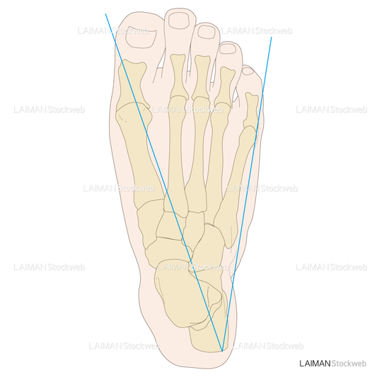 足部のアライメント 開帳足