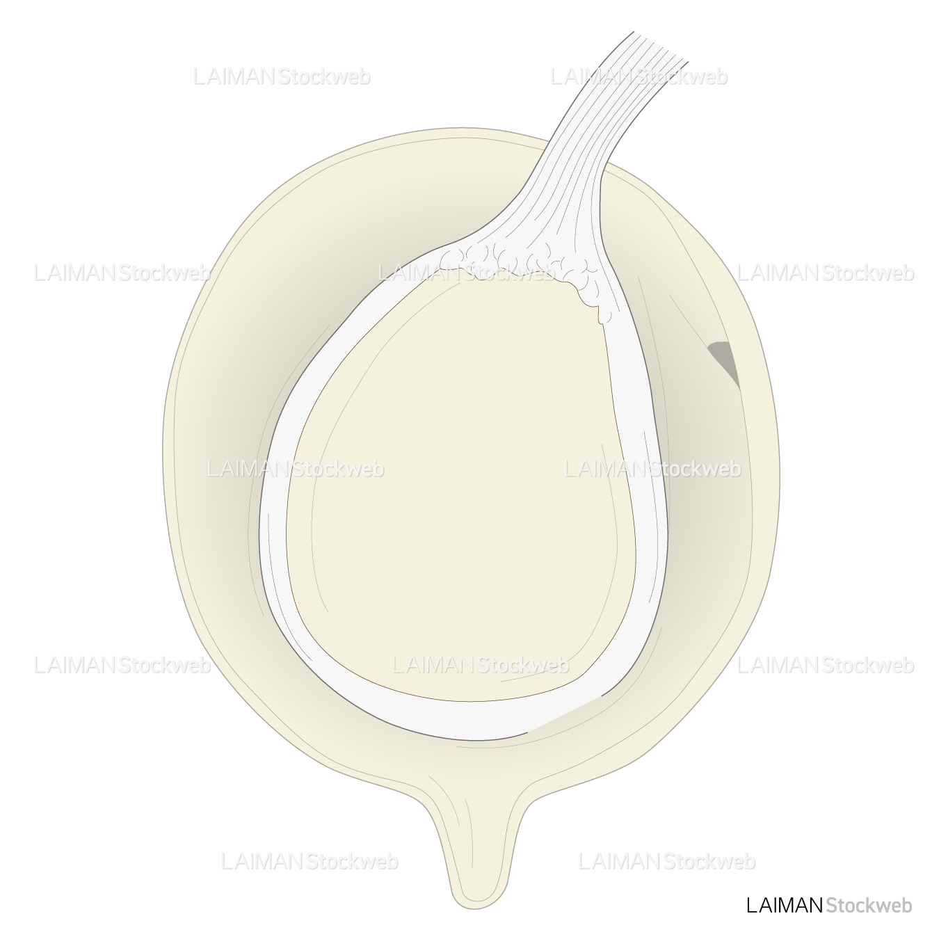 SLAP lesionに対するSnyder分類 TypeⅠ