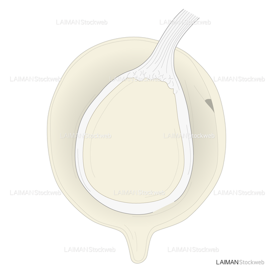 SLAP lesionに対するSnyder分類 TypeⅠ