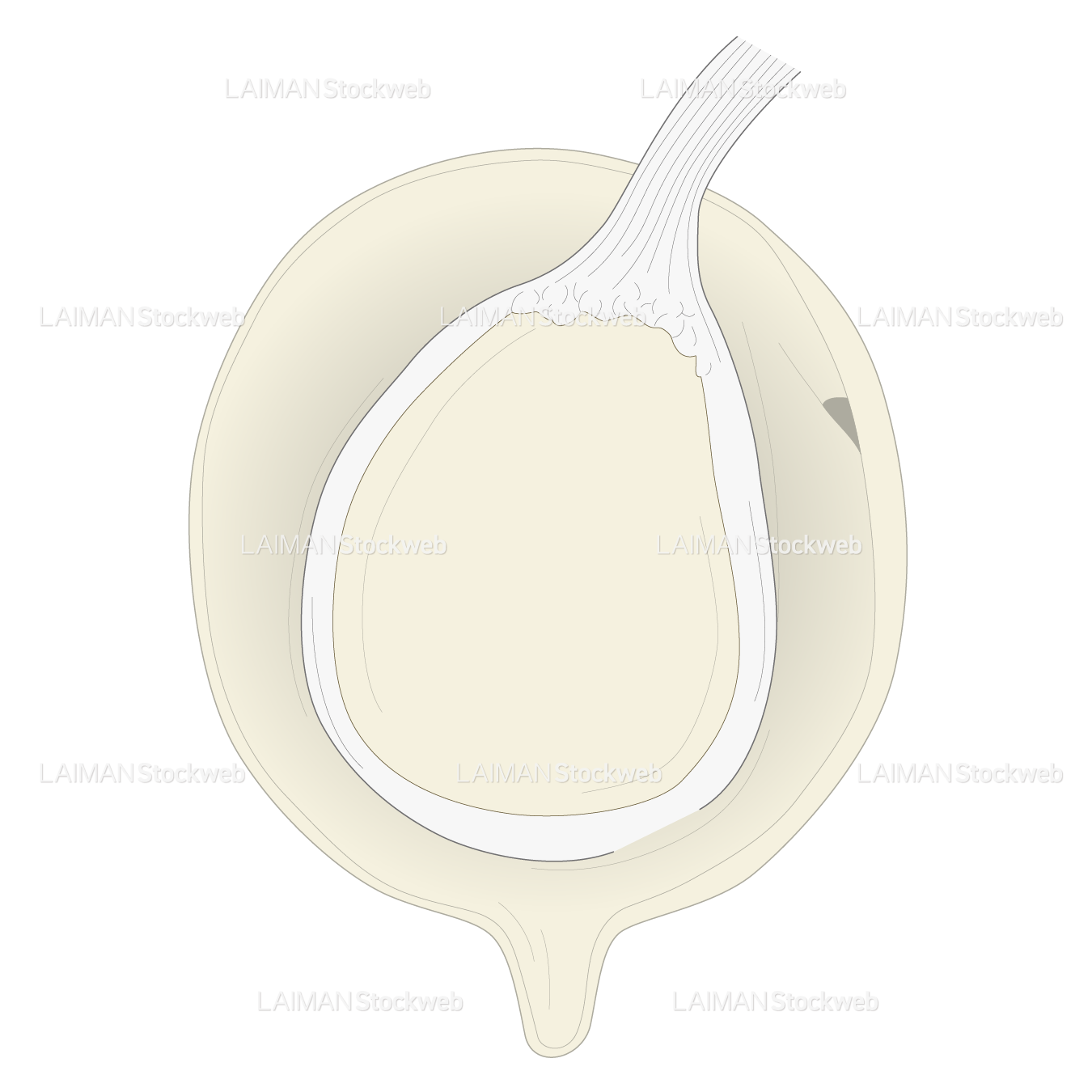 SLAP lesionに対するSnyder分類 TypeⅠ