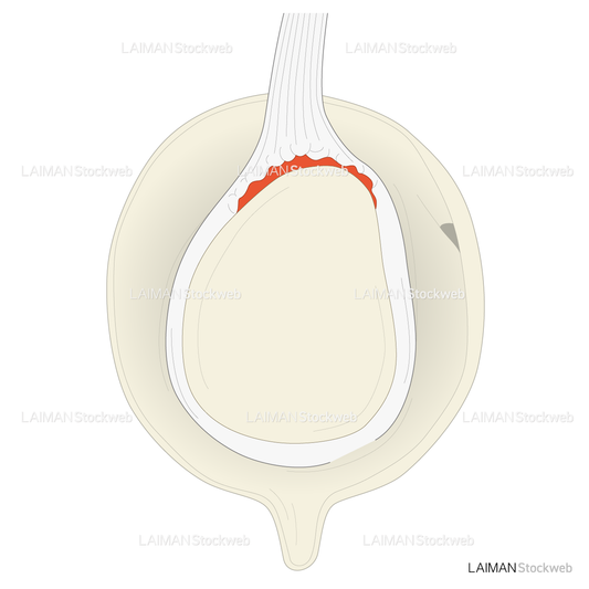 SLAP lesionに対するSnyder分類 TypeⅡ