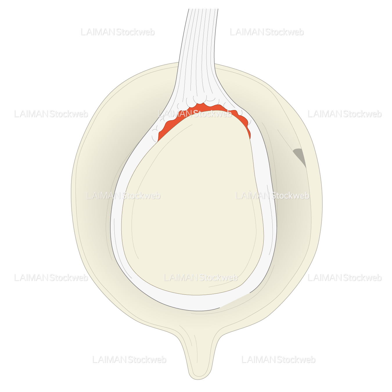 SLAP lesionに対するSnyder分類 TypeⅡ