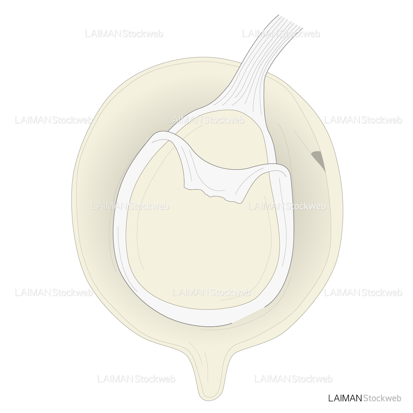 SLAP lesionに対するSnyder分類 TypeⅢ