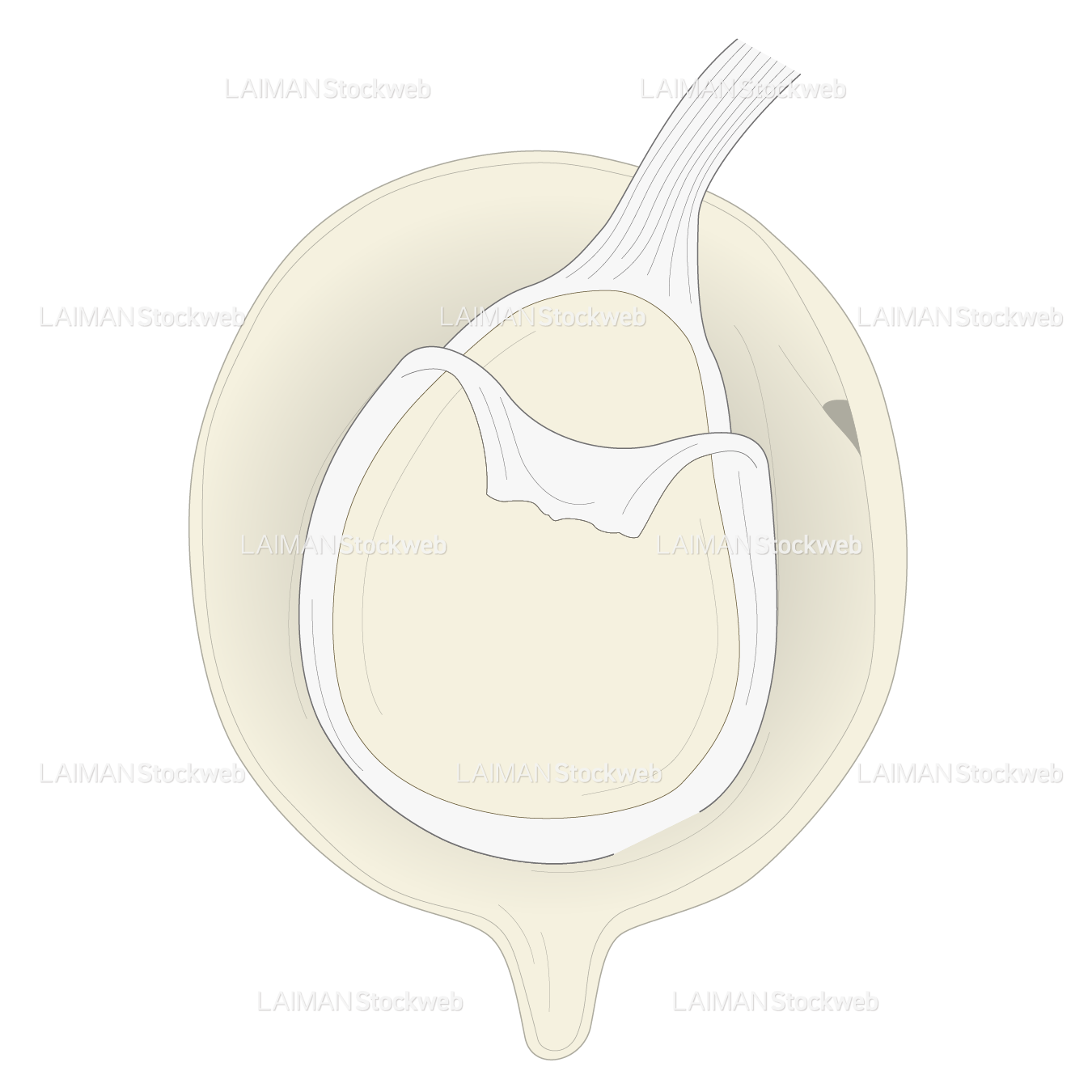 SLAP lesionに対するSnyder分類 TypeⅢ